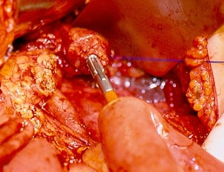 Postoperative stricture development at the esophagogastric anastomosis (Courtesy Dr. V. Penopoulos)