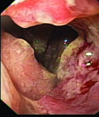Postoperative stricture development at the esophagogastric anastomosis (Courtesy Dr. V. Penopoulos)