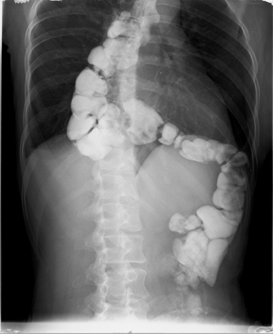 Postoperative stricture development at the esophagogastric anastomosis (Courtesy Dr. V. Penopoulos)