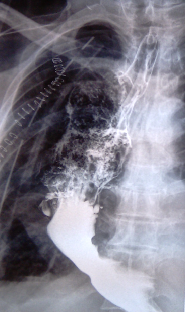 Postoperative stricture development at the esophagogastric anastomosis (Courtesy Dr. V. Penopoulos)