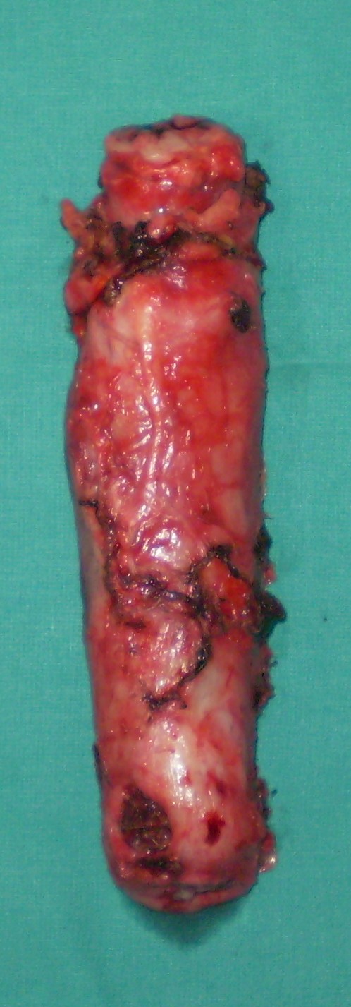 Postoperative stricture development at the esophagogastric anastomosis (Courtesy Dr. V. Penopoulos)