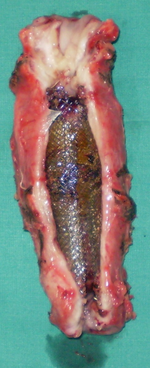 Postoperative stricture development at the esophagogastric anastomosis (Courtesy Dr. V. Penopoulos)