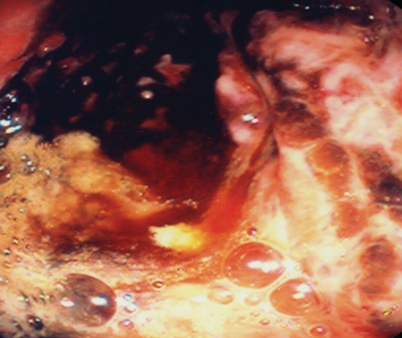 Burns from ingestion of acids (Courtesy Dr. V. Penopoulos)