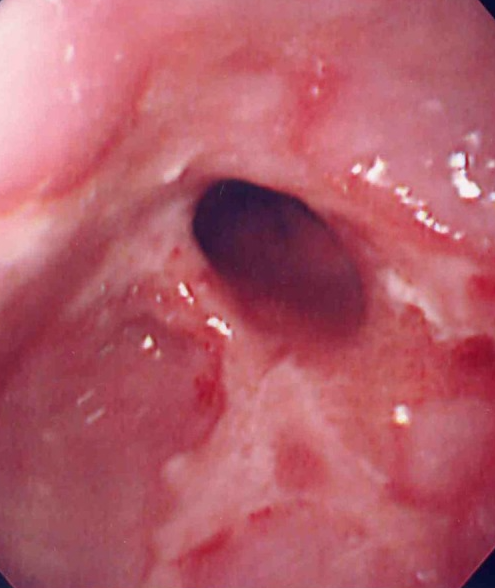 Postoperative stricture development at the esophagogastric anastomosis (Courtesy Dr. V. Penopoulos)