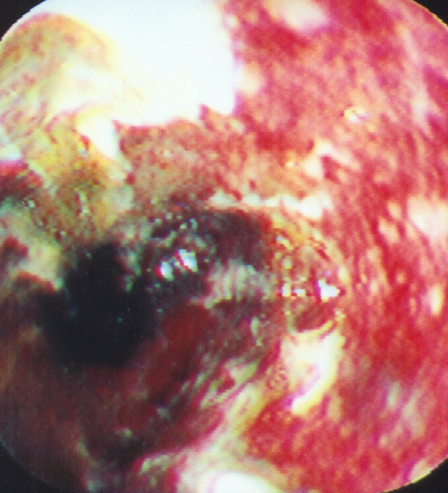 Esophagograms. Esophageal strictures (Courtesy Dr. V. Penopoulos)