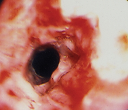 Gastric burns (Courtesy Dr. V. Penopoulos)