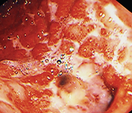 Gastric burn. Pyloric stricture (Courtesy Dr. V. Penopoulos)