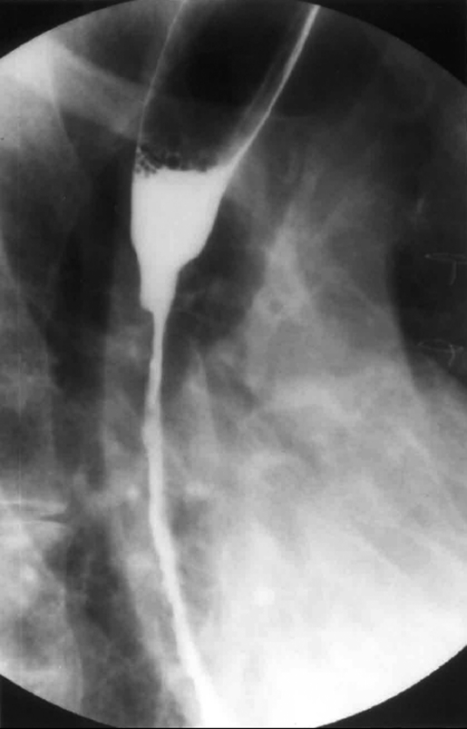 Gastric burns - Contained perforation (Courtesy Dr. V. Penopoulos)