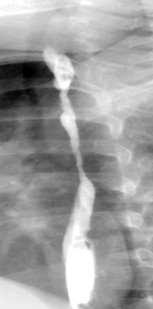 Endoscopic image of esophagogastric anastomosis (Courtesy Dr. V. Penopoulos)