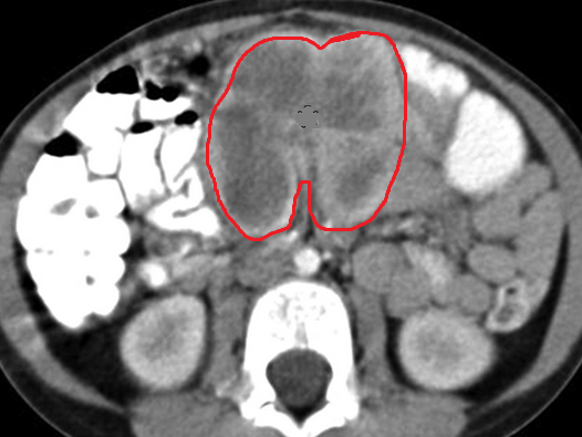 Double duct sign – Pseudotumor of the pancreatic head (Courtesy Dr. V. Penopoulos)