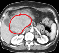 Double duct sign – Pseudotumor of the pancreatic head (Courtesy Dr. V. Penopoulos)