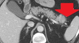 Double duct sign – Pseudotumor of the pancreatic head (Courtesy Dr. V. Penopoulos)