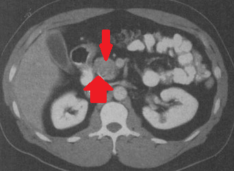 Double duct sign – Pseudotumor of the pancreatic head (Courtesy Dr. V. Penopoulos)