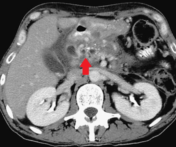 Double duct sign – Pseudotumor of the pancreatic head (Courtesy Dr. V. Penopoulos)
