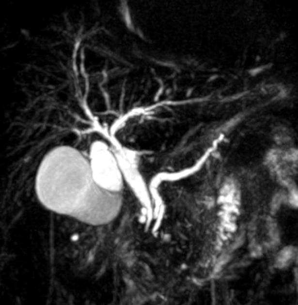 Double duct sign – Pseudotumor of the pancreatic head (Courtesy Dr. V. Penopoulos)