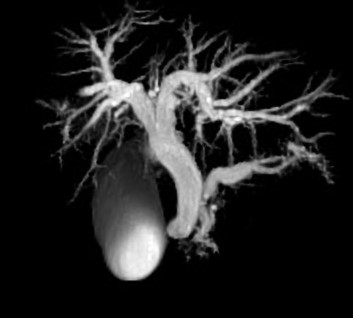Double duct sign – Pseudotumor of the pancreatic head (Courtesy Dr. V. Penopoulos)