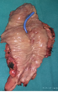 The preoperative placement of a plastic stent in the common bile duct is visible (Courtesy Dr. V. Penopoulos)