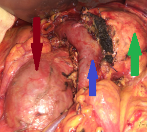 After completion of the pancreatic head resection, the following are demonstrated: (brown arrow) the AAA sac, (blue arrow) the confluence of the superior mesenteric vein with the splenic vein and the formation of the portal vein, and (green arrow) the body of the pancreas (Courtesy Dr. V. Penopoulos)
