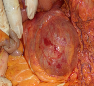 The continuation of the AAA sac below the level of the ligament of Treitz (Courtesy Dr. V. Penopoulos)