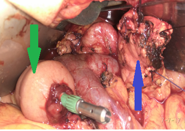 Blue arrow – The body of the pancreas, fully mobilized, ready for the pancreaticogastric anastomosis, and Green arrow – Jejunal loop, ready for the gastrojejunal anastomosis (Courtesy Dr. V. Penopoulos)