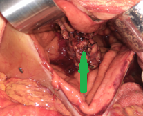 Completion of the pancreaticogastric anastomosis – Green arrow – demonstrates the pancreas secured within the gastric lumen (Courtesy Dr. V. Penopoulos)