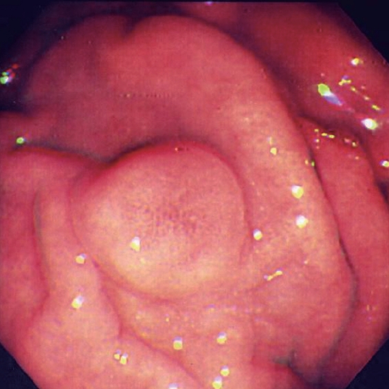 Total gastrectomy specimen. Brown arrows – Multiple gastric stromal tumors (Courtesy Dr. V. Penopoulos)