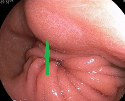 Total gastrectomy specimen. Brown arrows – Multiple gastric stromal tumors (Courtesy Dr. V. Penopoulos)