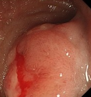 Total gastrectomy specimen. Brown arrows – Multiple gastric stromal tumors (Courtesy Dr. V. Penopoulos)