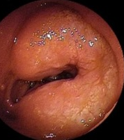 Total gastrectomy specimen. Brown arrows – Multiple gastric stromal tumors (Courtesy Dr. V. Penopoulos)