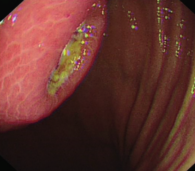 Total gastrectomy specimen. Brown arrows – Multiple gastric stromal tumors (Courtesy Dr. V. Penopoulos)