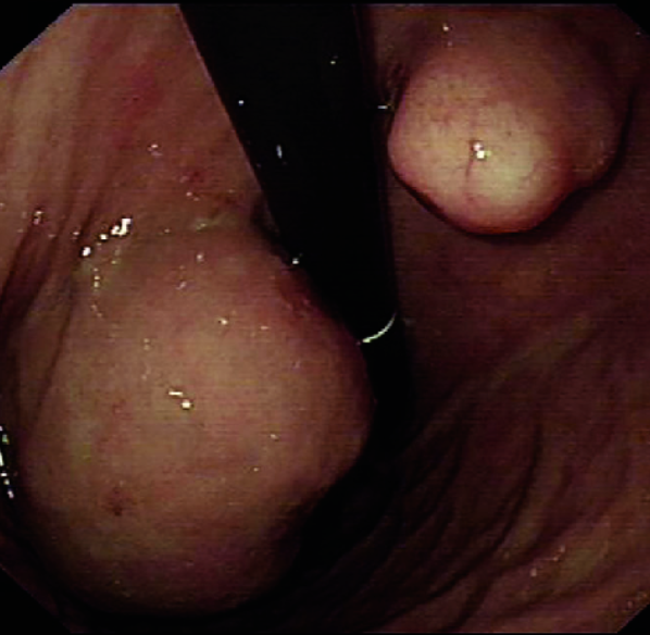 Total gastrectomy specimen. Brown arrows – Multiple gastric stromal tumors (Courtesy Dr. V. Penopoulos)