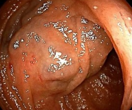 Total gastrectomy specimen. Brown arrows – Multiple gastric stromal tumors (Courtesy Dr. V. Penopoulos)