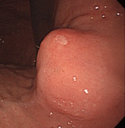 Total gastrectomy specimen. Brown arrows – Multiple gastric stromal tumors (Courtesy Dr. V. Penopoulos)
