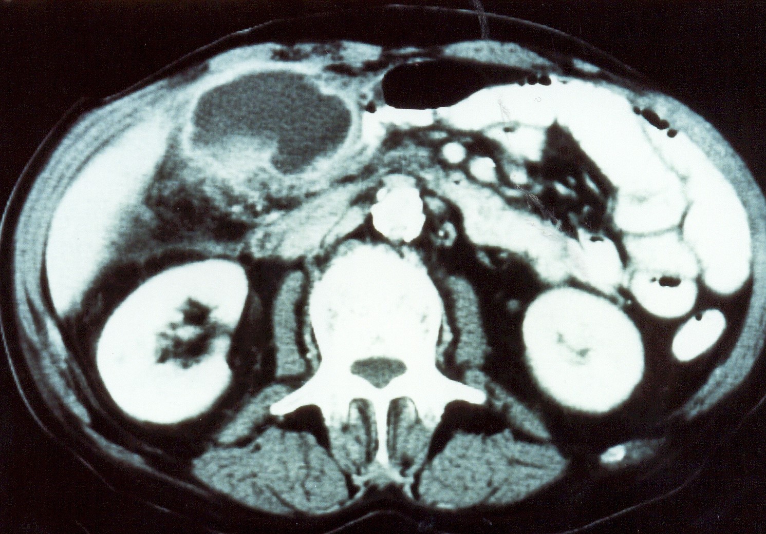 Total gastrectomy specimen. Brown arrows – Multiple gastric stromal tumors (Courtesy Dr. V. Penopoulos)