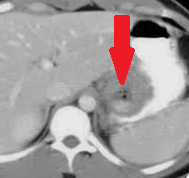 Total gastrectomy specimen. Brown arrows – Multiple gastric stromal tumors (Courtesy Dr. V. Penopoulos)
