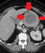 Total gastrectomy specimen. Brown arrows – Multiple gastric stromal tumors (Courtesy Dr. V. Penopoulos)