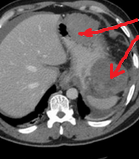 Total gastrectomy specimen. Brown arrows – Multiple gastric stromal tumors (Courtesy Dr. V. Penopoulos)