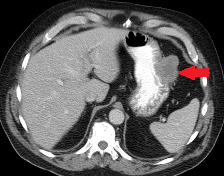 Total gastrectomy specimen. Brown arrows – Multiple gastric stromal tumors (Courtesy Dr. V. Penopoulos)