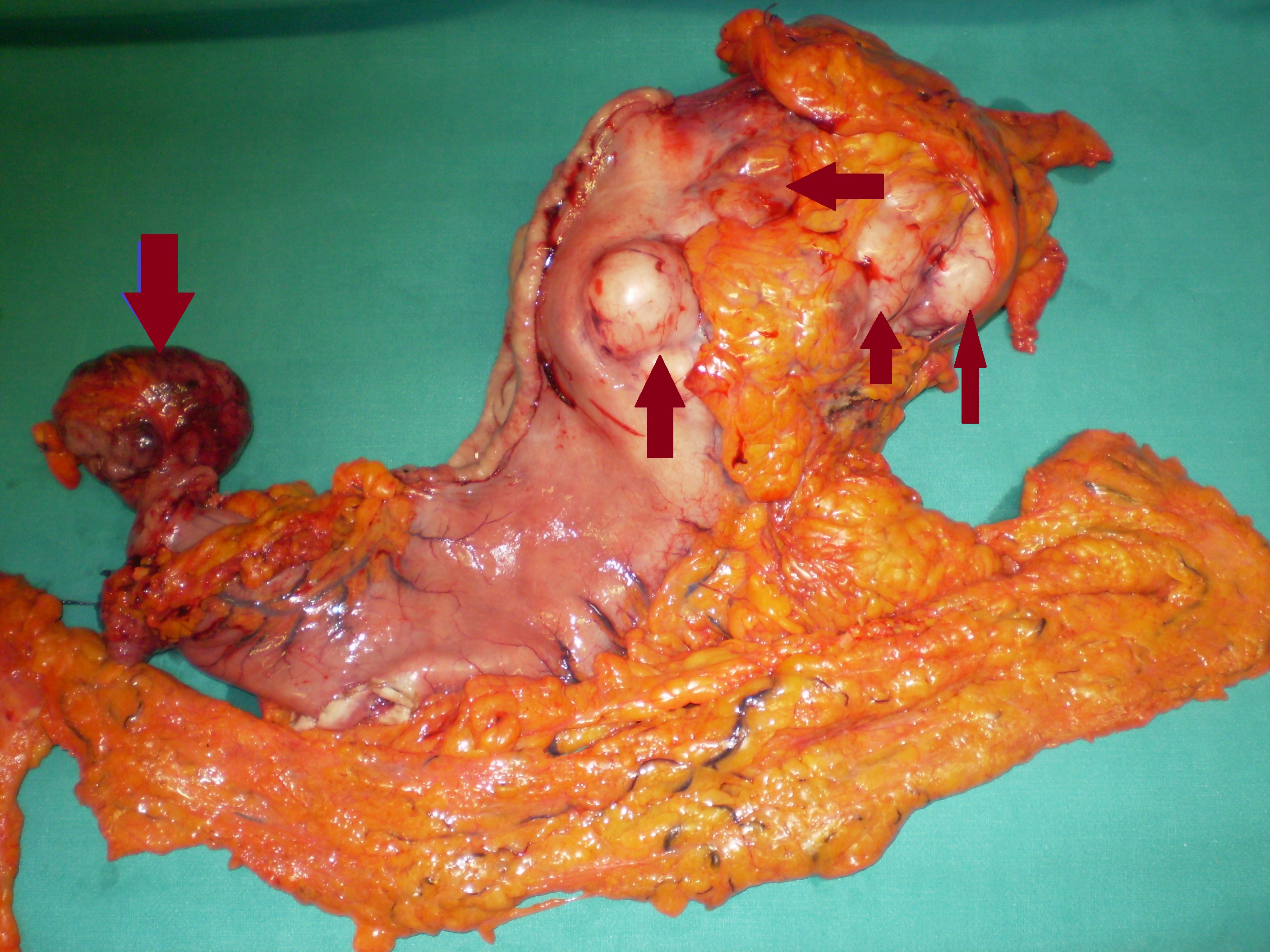 Total gastrectomy specimen. Brown arrows – Multiple gastric stromal tumors (Courtesy Dr. V. Penopoulos)