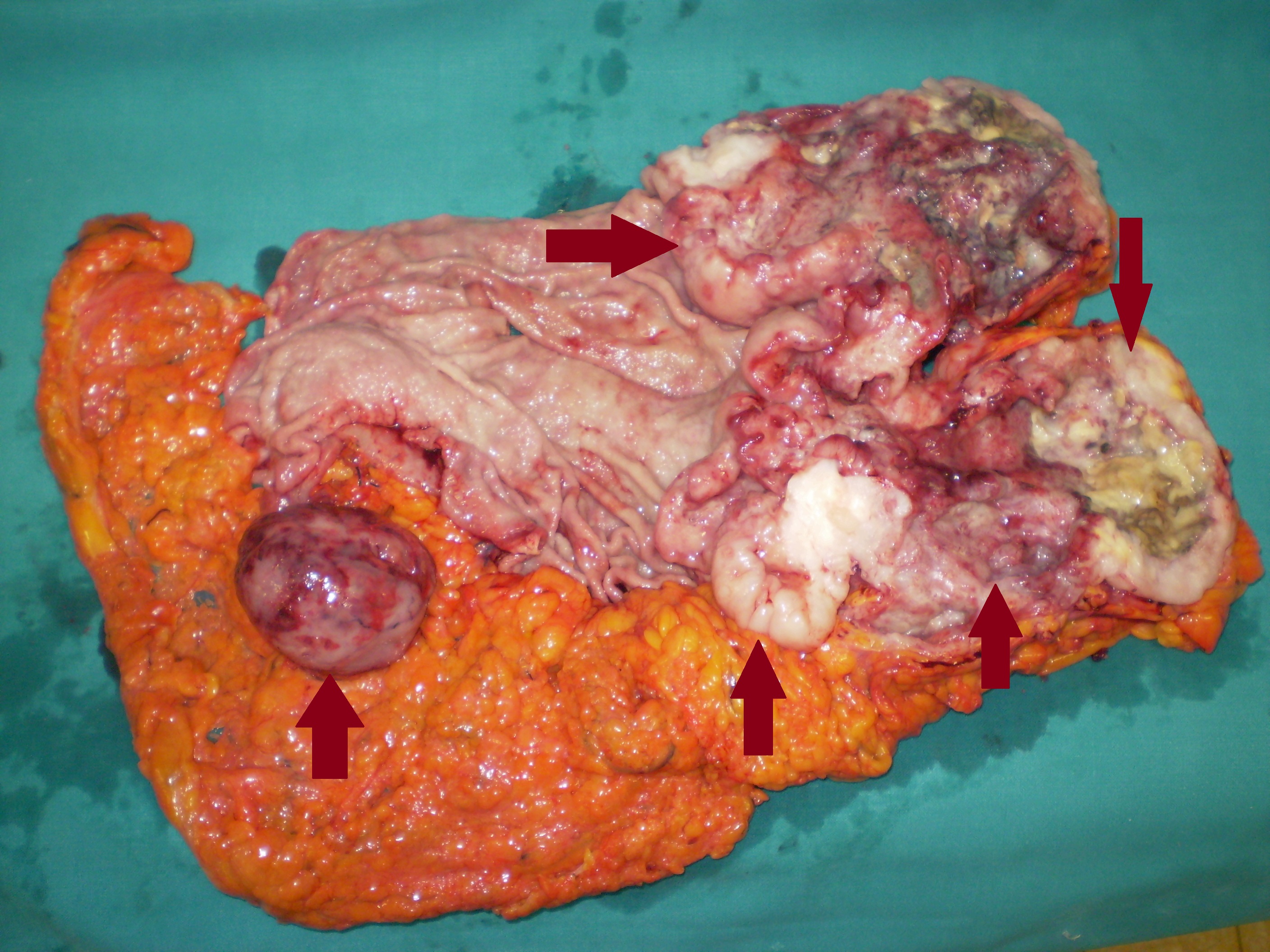 Total gastrectomy specimen. Brown arrows – Multiple gastric stromal tumors (Courtesy Dr. V. Penopoulos)