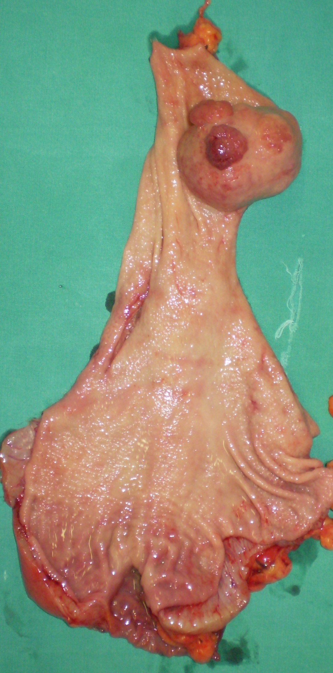 Giant gastric stromal tumors (Courtesy Dr. V. Penopoulos)