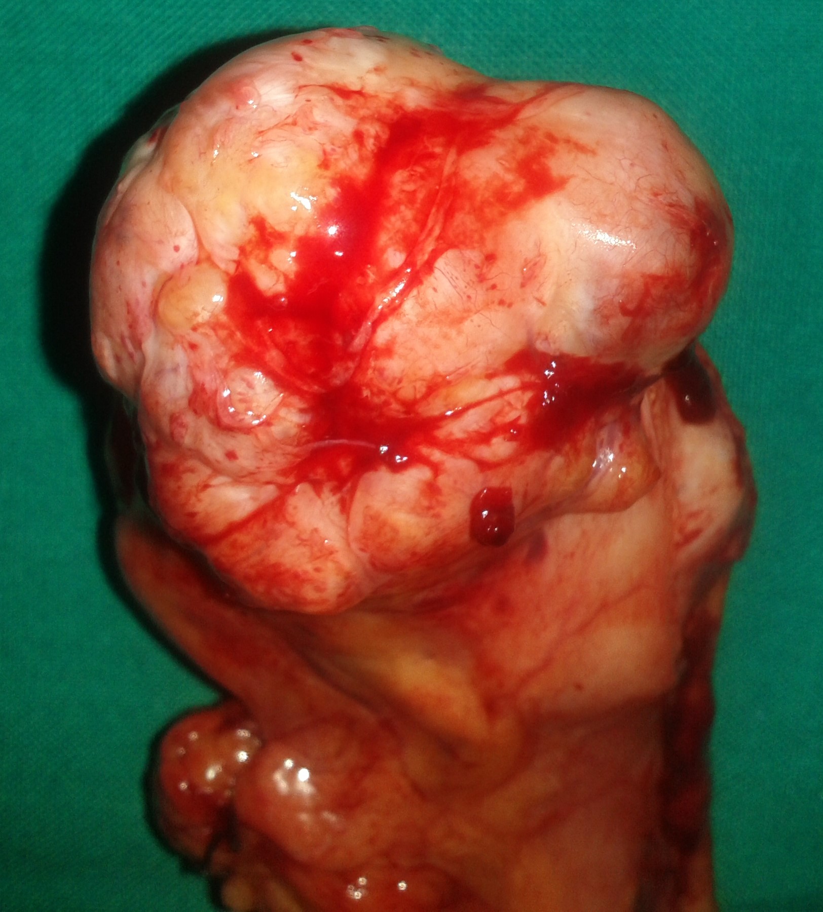 Red arrows – Rectal stromal tumor. Multiple liver metastases (Courtesy Dr. V. Penopoulos)