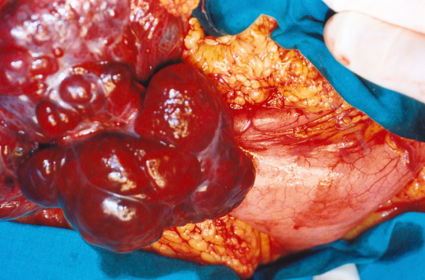 Gastric carcinoid (Courtesy Dr. V. Penopoulos)