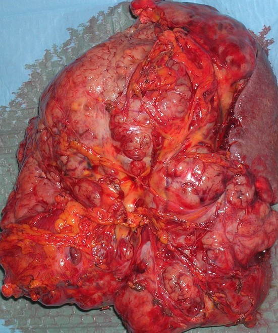 Inflammatory myofibroblastic tumor of the stomach (Courtesy Dr. V. Penopoulos)