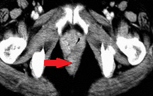 Endoscopic view of multiple gastric stromal tumors after suctioning of hemorrhagic products (Courtesy Dr. V. Penopoulos)