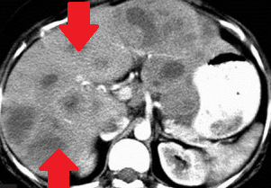 Abdominal CT scans. Gastric stromal tumors (Courtesy Dr. V. Penopoulos)