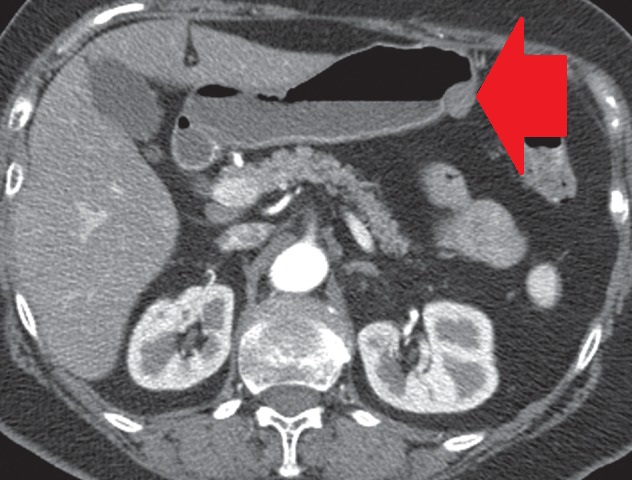 Total gastrectomy specimen. Brown arrows – Multiple gastric stromal tumors (Courtesy Dr. V. Penopoulos)