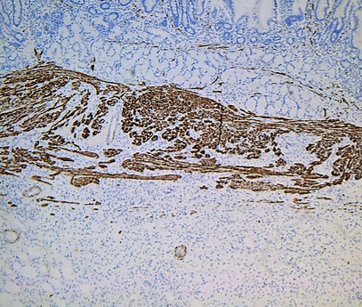 Immunohistochemical staining with anti-CD117 antibody – Positive expression in mast cells and negative expression in elongated spindle cells (Courtesy Dr. V. Penopoulos)