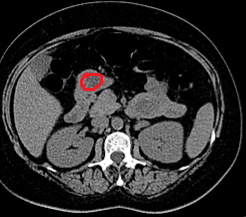 Abdominal CT scan. Red outline – Inflammatory fibroid polyp of the duodenum (Courtesy Dr. V. Penopoulos)