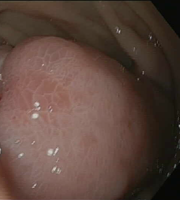 Inflammatory fibroid polyp of the duodenum – Complete endoscopic removal of the IFP (Courtesy Dr. V. Penopoulos)